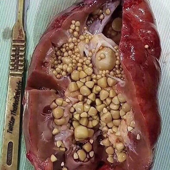 肾窦区结石图片图片