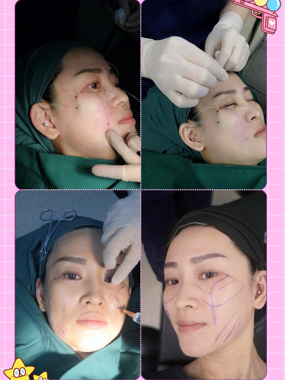 线雕?说起保养,很多人都说,"买_圈子-新氧美容整形