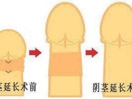 由于脂肪易被吸收,阴茎增大增粗手术后效果一般需要2到3次!