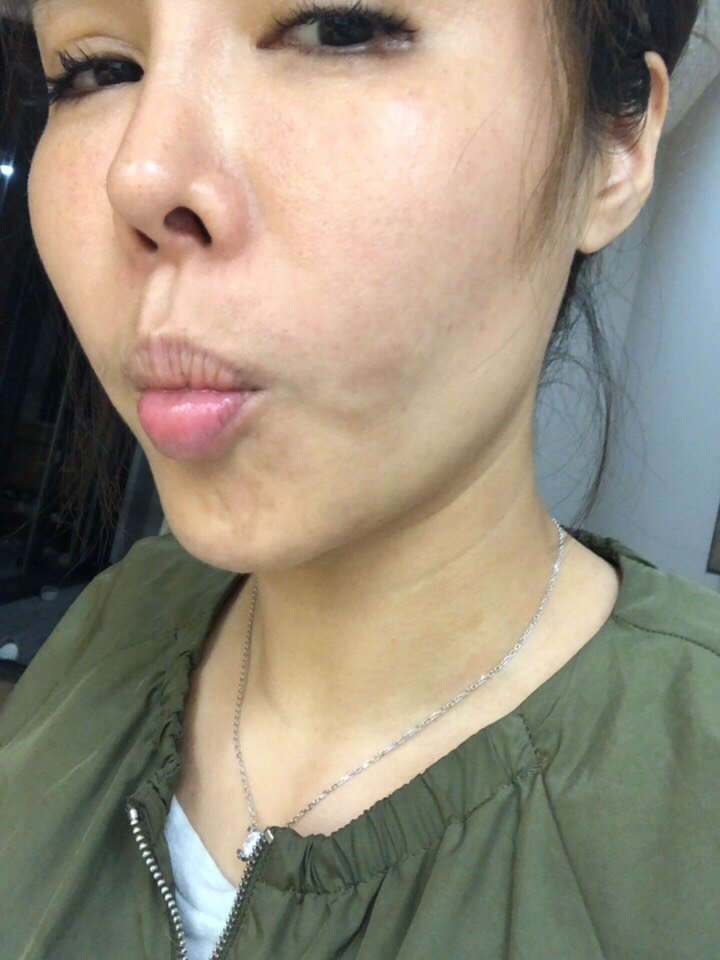 有没有人跟我一样经历的两年前打了童颜针又注射溶脂针_圈子-新氧美容