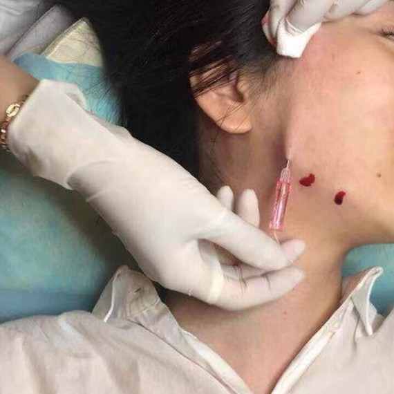 揭秘最真实的水光韧带大v线提升.po主今年26岁已_圈子-新氧美容整形