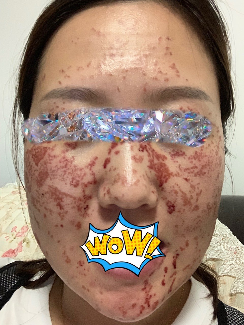 吓死人的激光祛斑.我这次做的是调q.