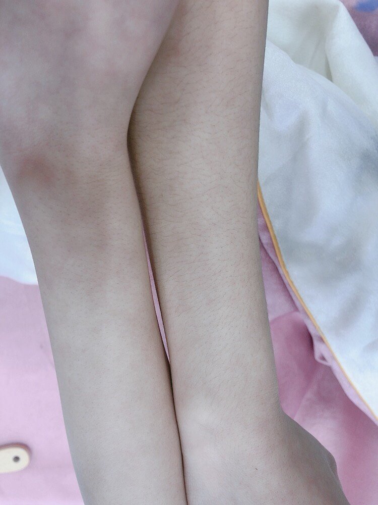 千万千万不要做冰点脱毛!不然你会后悔没早一点做脱毛