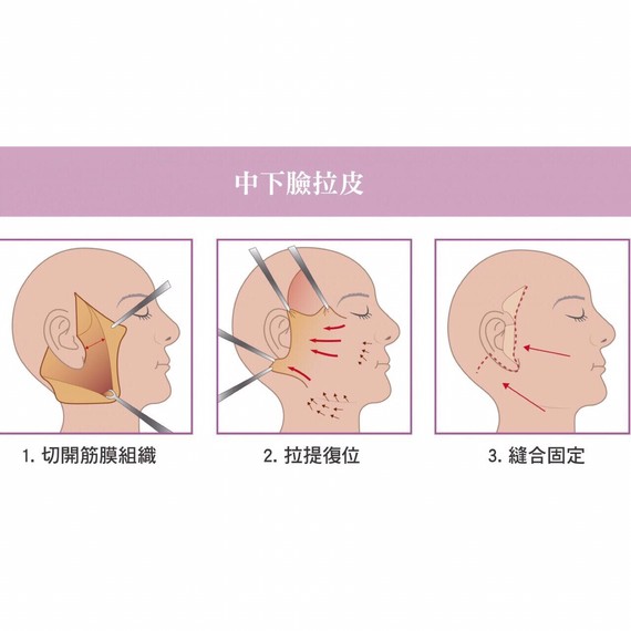面部拉皮除皱术后护理:1,手术后可在红肿处进行冷敷,使其尽快消肿