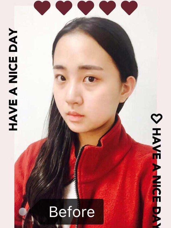 我不就是想割个双眼皮吗亲,你们医院做双眼皮