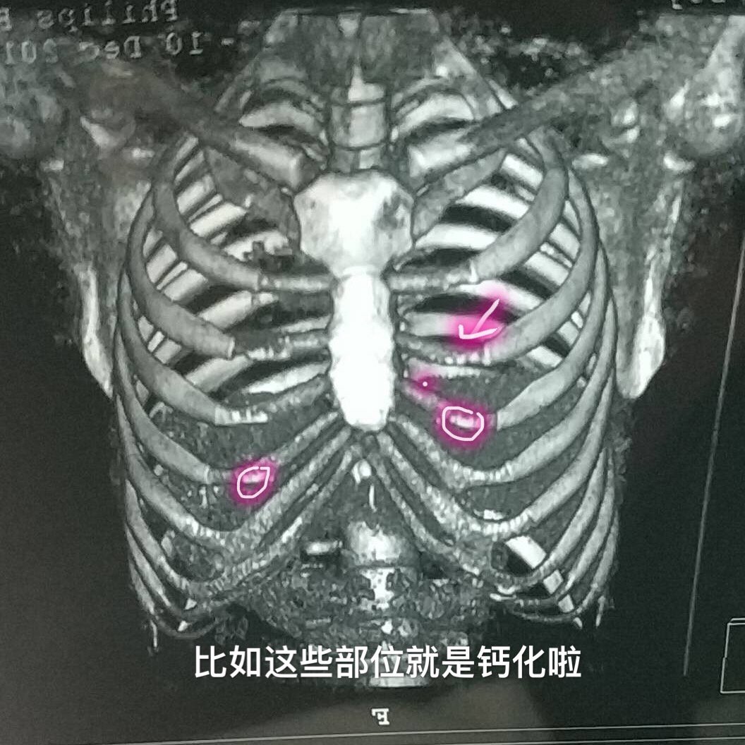 关于肋软骨钙化的小tips