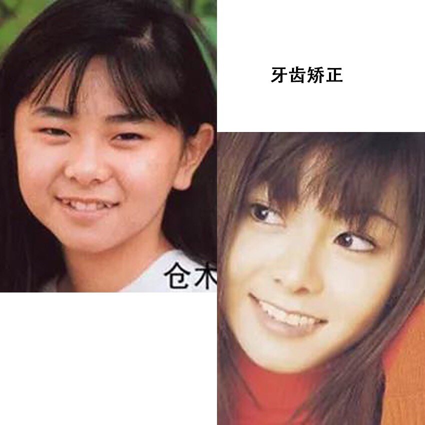 歌姬 归来 是童颜 还是崩坏 长开了还是整容 圈子 新氧美容整形