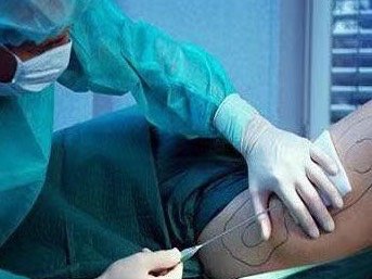 一般抽脂手术的价格,靠抽脂手术就能一劳永逸