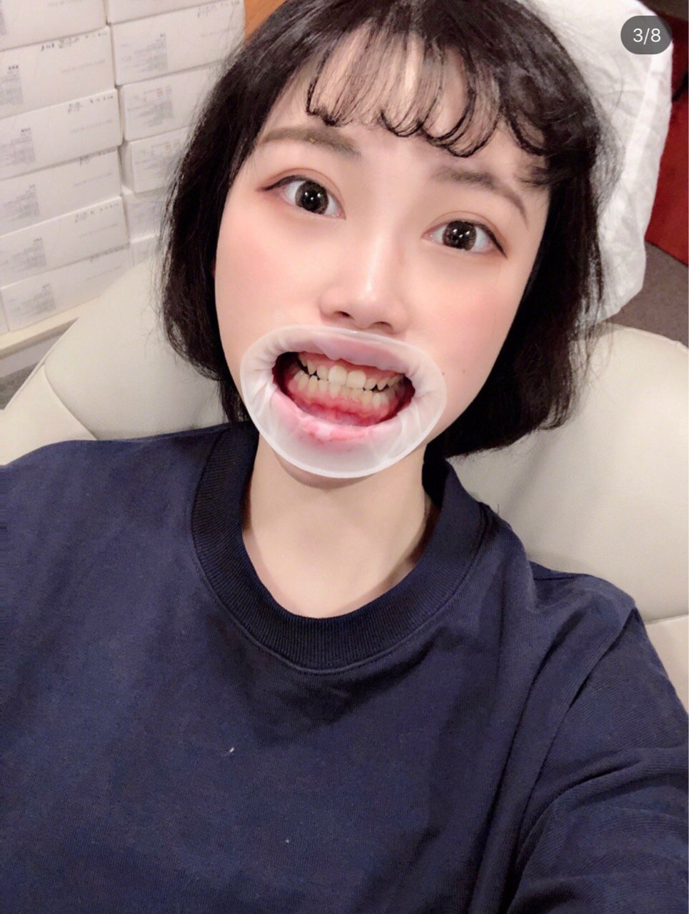 牙套选择以及牙套07初体验—吃了我这口安利牙齿_圈子-新氧美容整形