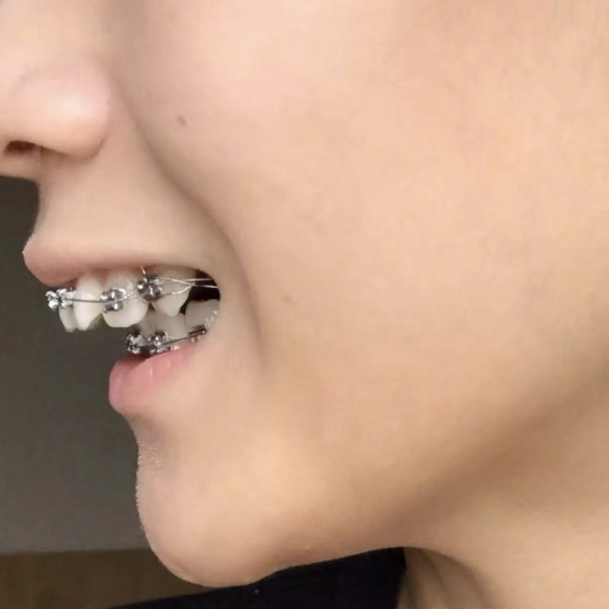 戴牙套堪比削骨?牙套全记录