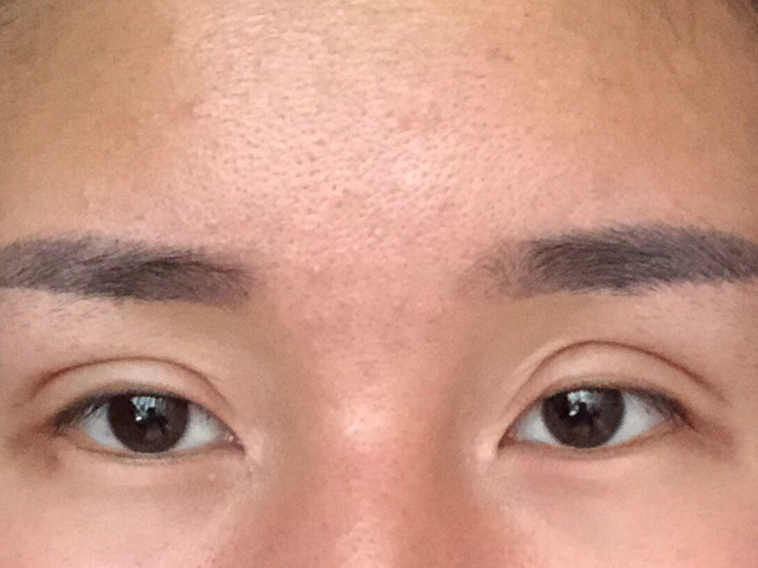 全切双眼皮52天形状不规则线条不流畅眼头宽眼睛无神_圈子-新氧美容