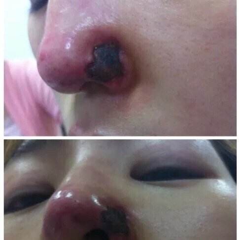 9797长期注射玻尿酸隆鼻有什么弊端?