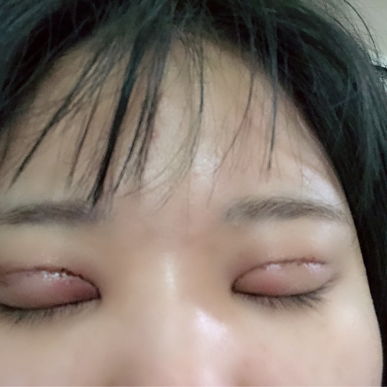 大家帮我看看我的双眼皮是不是割的太宽了,后悔死了,_圈子-新氧美容