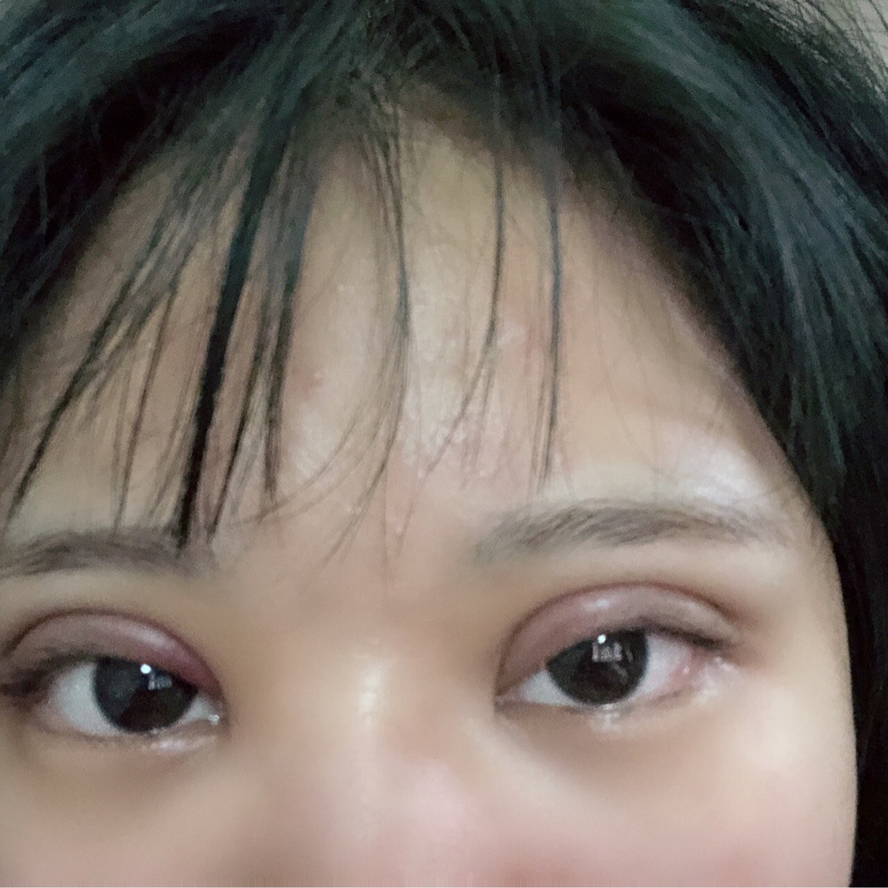 大家帮我看看我的双眼皮是不是割的太宽了,后悔死了,_圈子-新氧美容