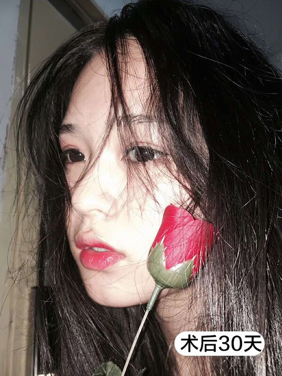 割双眼皮如何在面诊时评判出这个医生的水平?