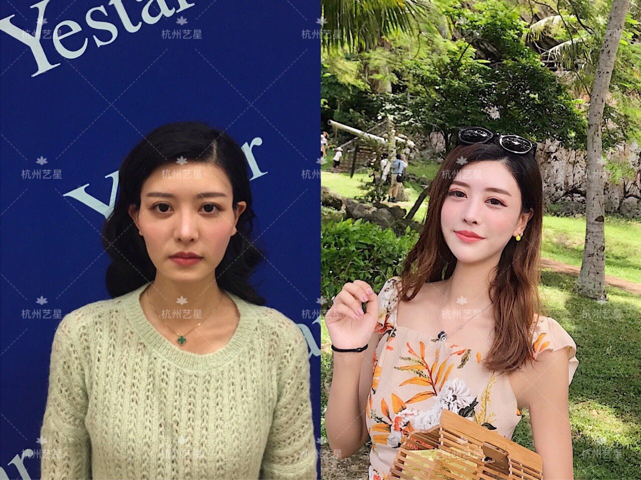面部填充整形_整形填充面部有风险吗_整形填充面部多久恢复
