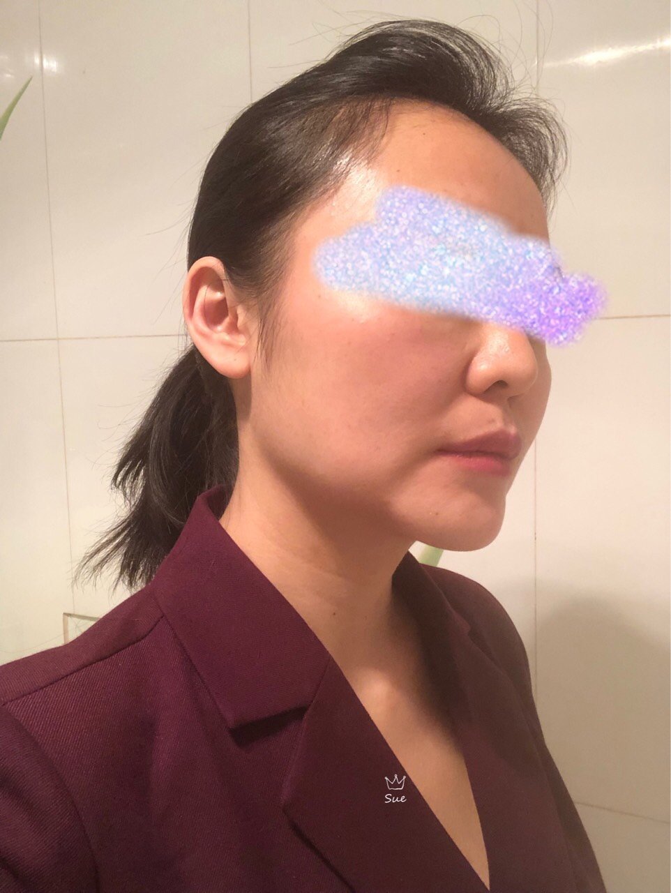 两个月前做的光纤溶脂和硅胶下巴,现在不仅脸部下垂,_圈子-新氧美容