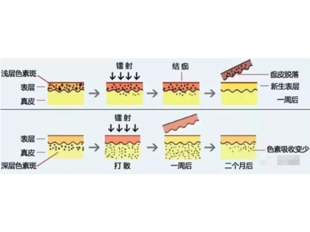 969696激光祛斑出现反黑现象并不是祛斑失败的一