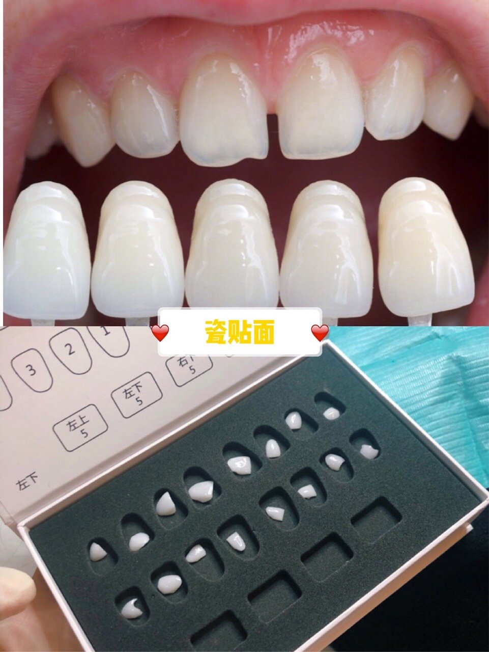 100分笑容之牙贴面🦷看到明星网红笑起来露出一口整_圈子-新氧美容