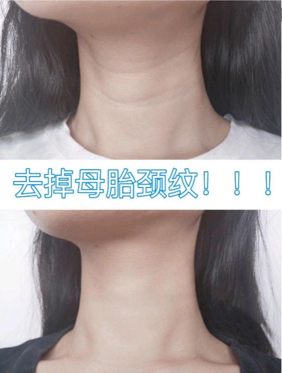 还你天鹅颈06嗨体去颈纹见过太多的姑娘,漂亮的脸蛋,_圈子-新氧美容