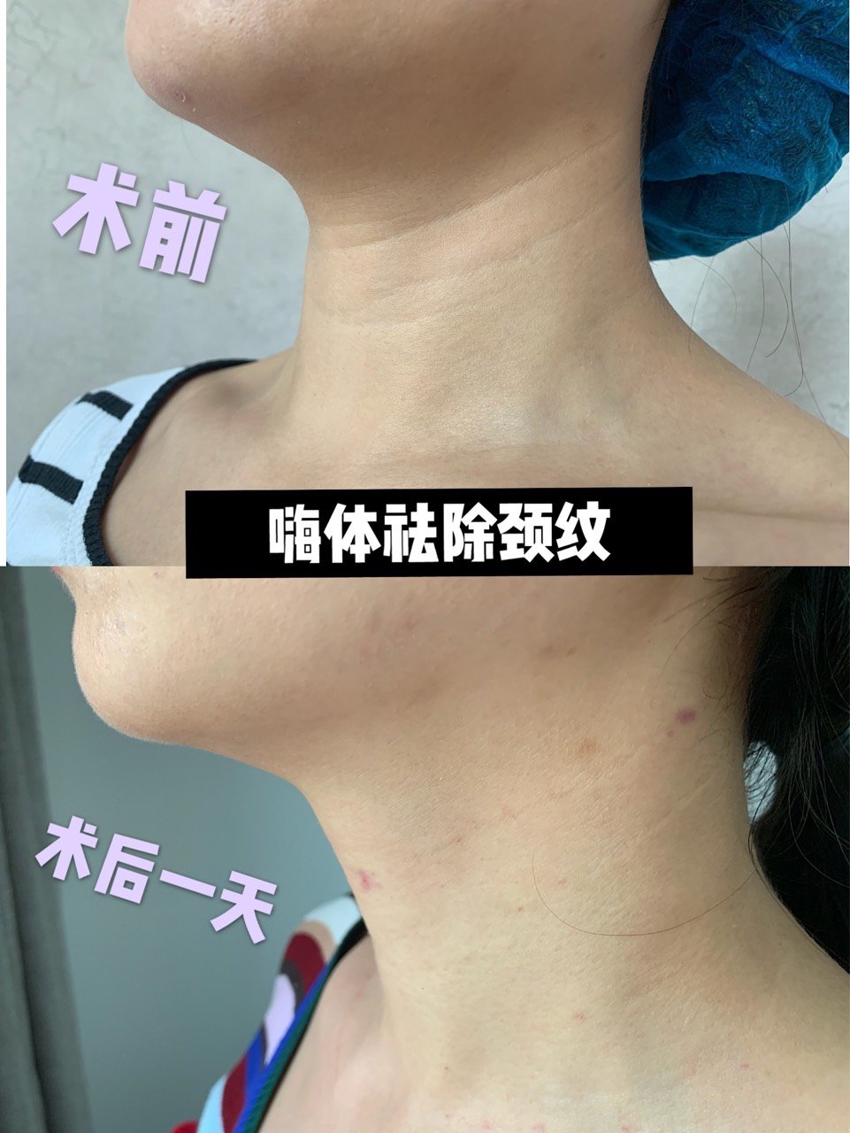 【医美篇:嗨体去颈纹最强全攻略】