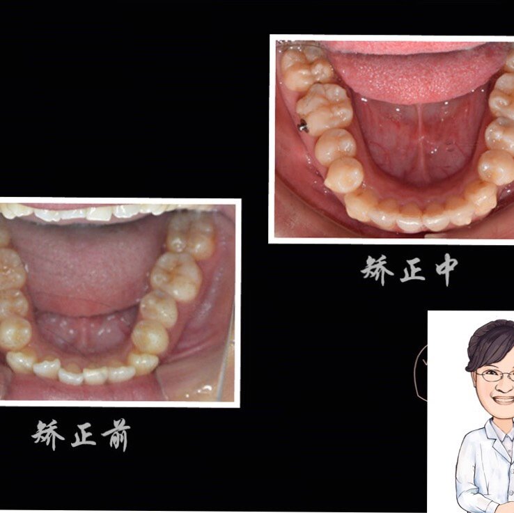牙弓不对称?弧度笑线不美观?美学矫正通通_圈子-新氧美容整形
