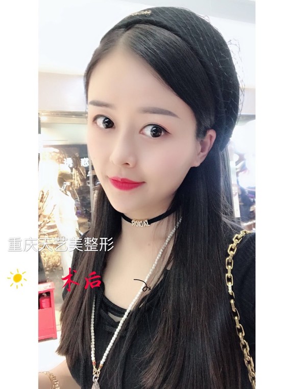 自体脂肪填充后,眼睛肿是怎么回事?自体脂肪填