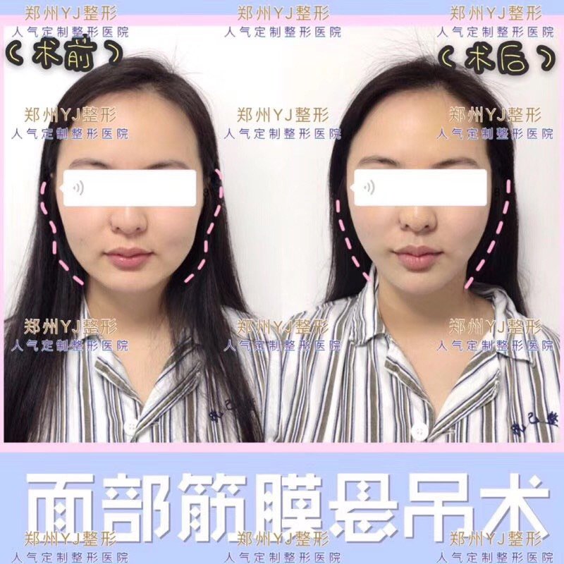 独家面部筋膜悬吊术后即刻对比不红不肿不需要恢复期