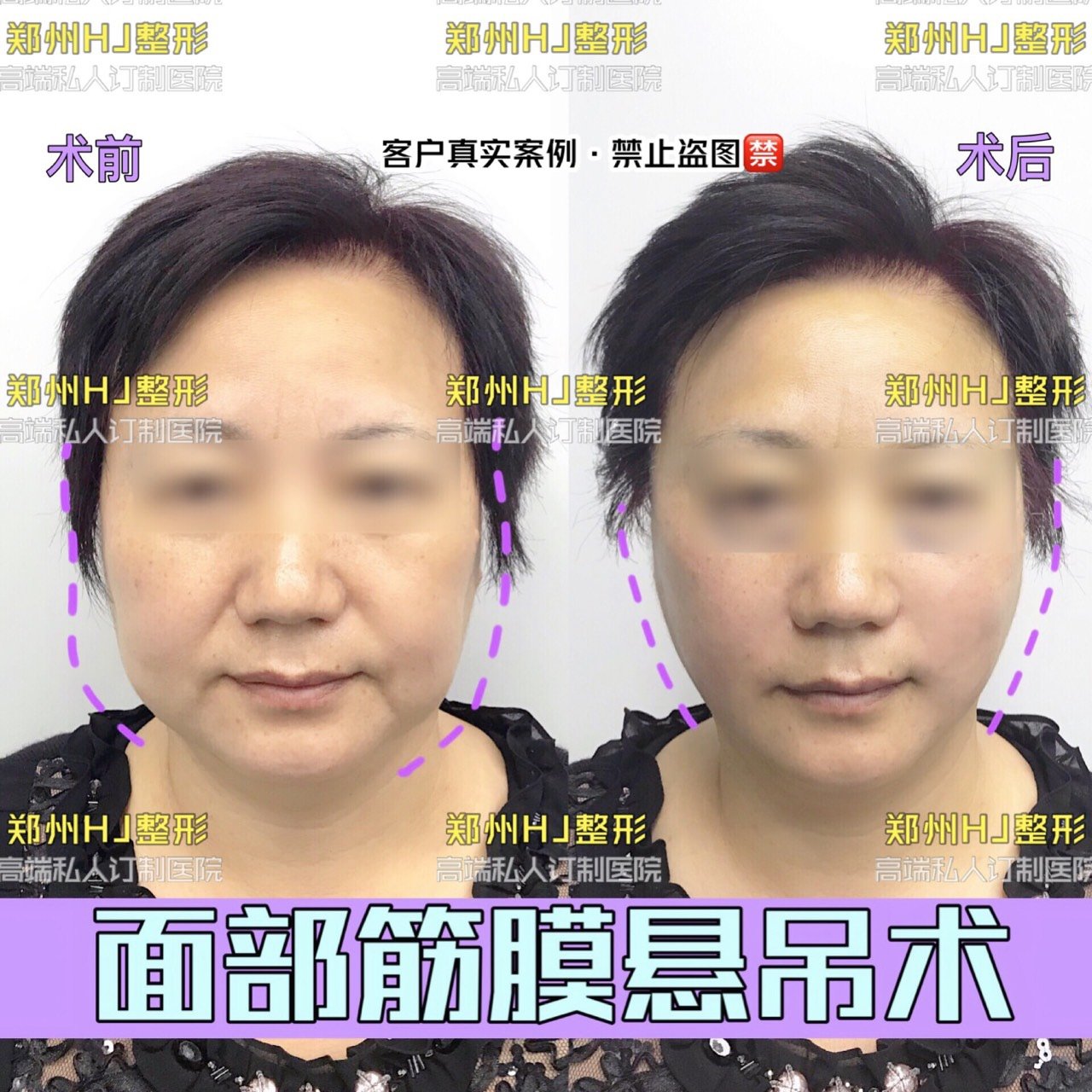 独家面部筋膜悬吊术后即刻对比不红不肿不需要恢复期