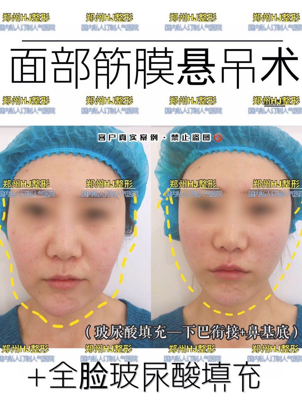独家面部筋膜悬吊术后即刻对比不红不肿不需要恢复期