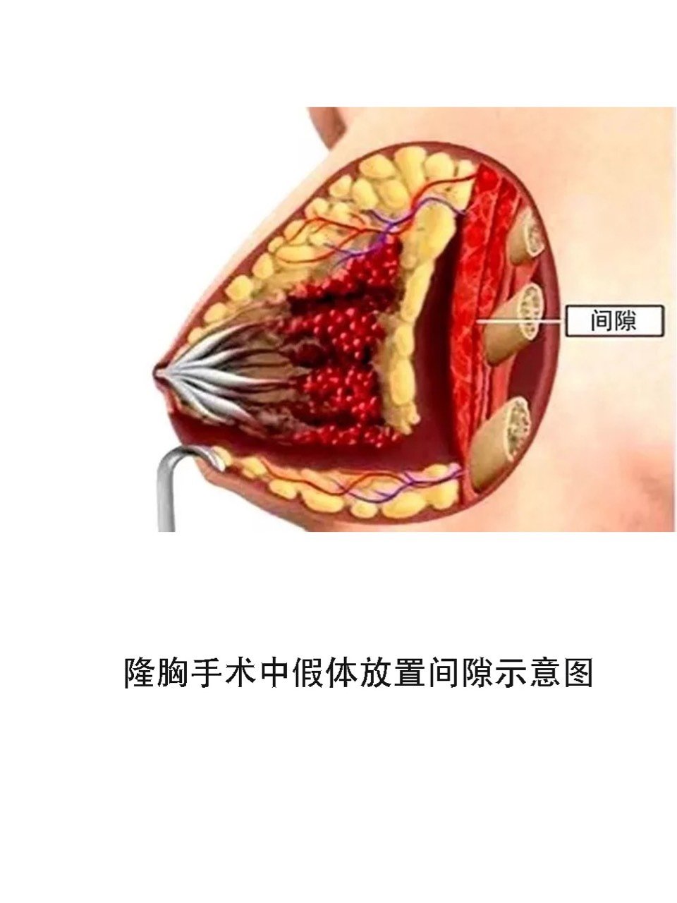 假体隆胸假体可以保持多久会不会发生破裂等现象