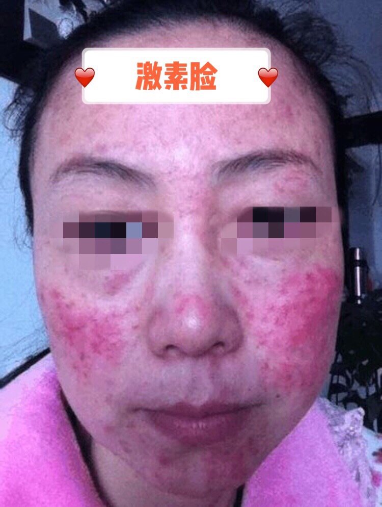 不打针不吃药—7天对抗激素脸