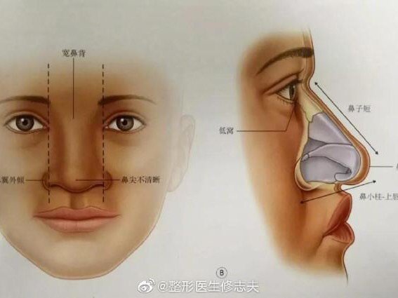 亚洲人鼻子的典型特征:皮肤或软组织厚,多脂肪,鼻根