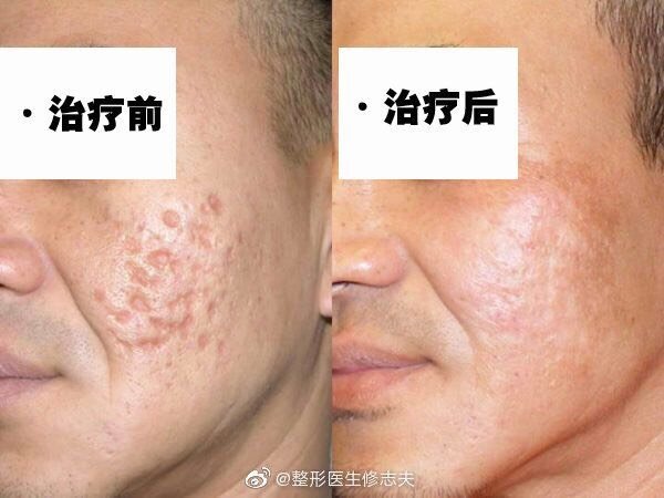 微针滚轮可以通过刺激真皮层胶原蛋白增生,让凹陷的部分逐渐变平,从而