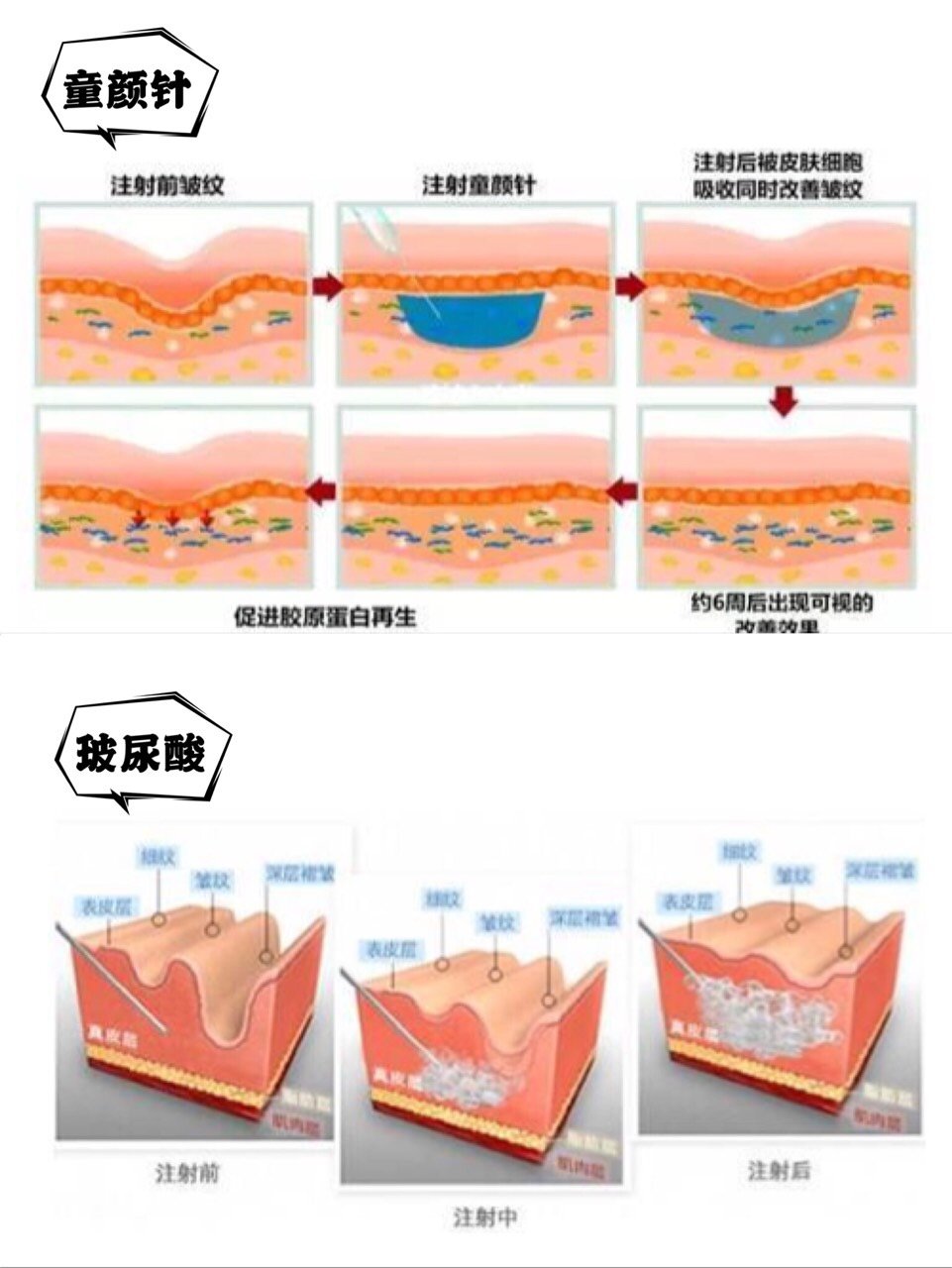 73都能塑形抗衰童顏針和玻尿酸有什麼區別哪個更好