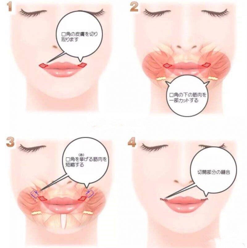 美学标准下的m唇最搭微笑唇