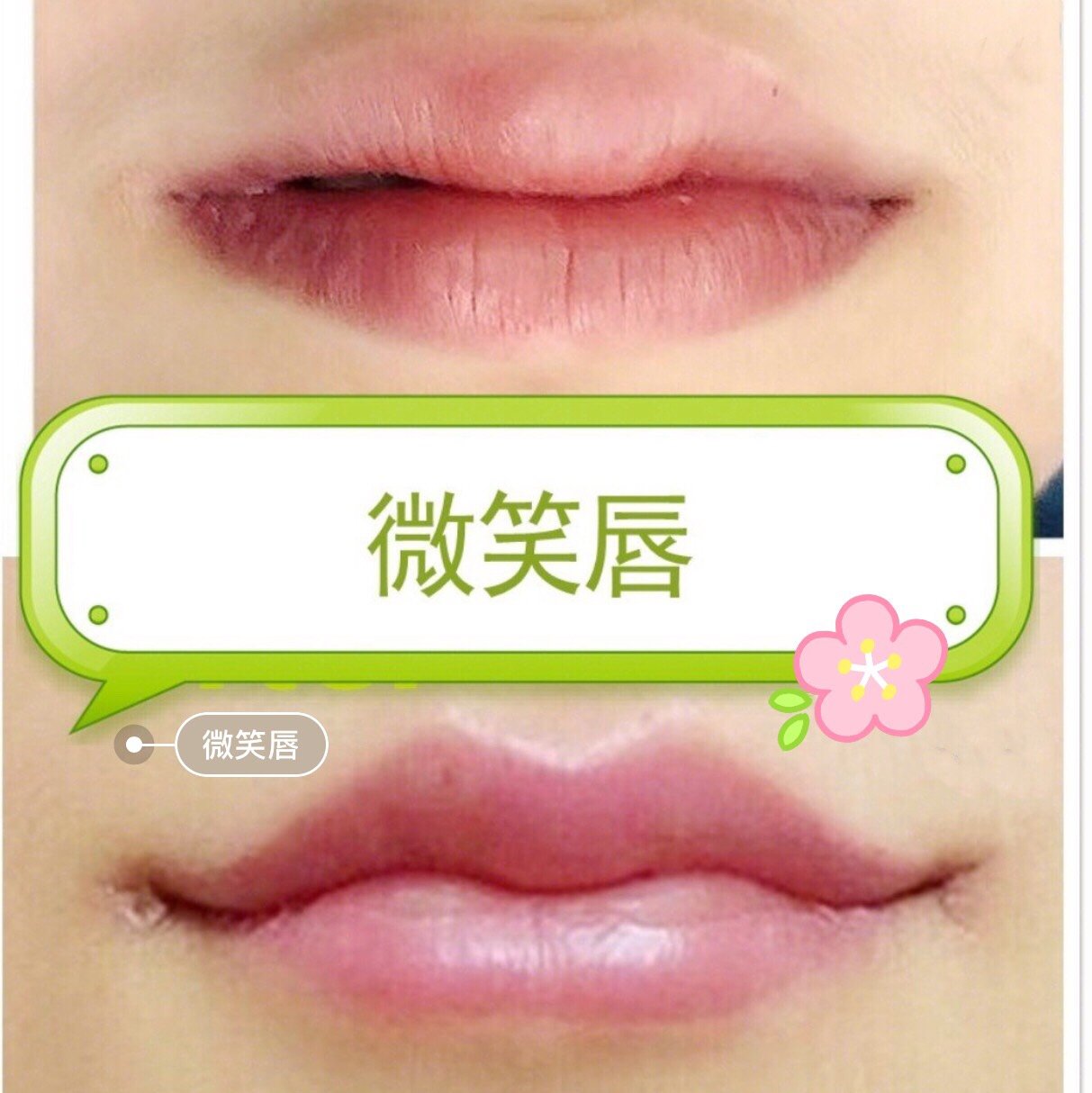 美学标准下的m唇最搭微笑唇