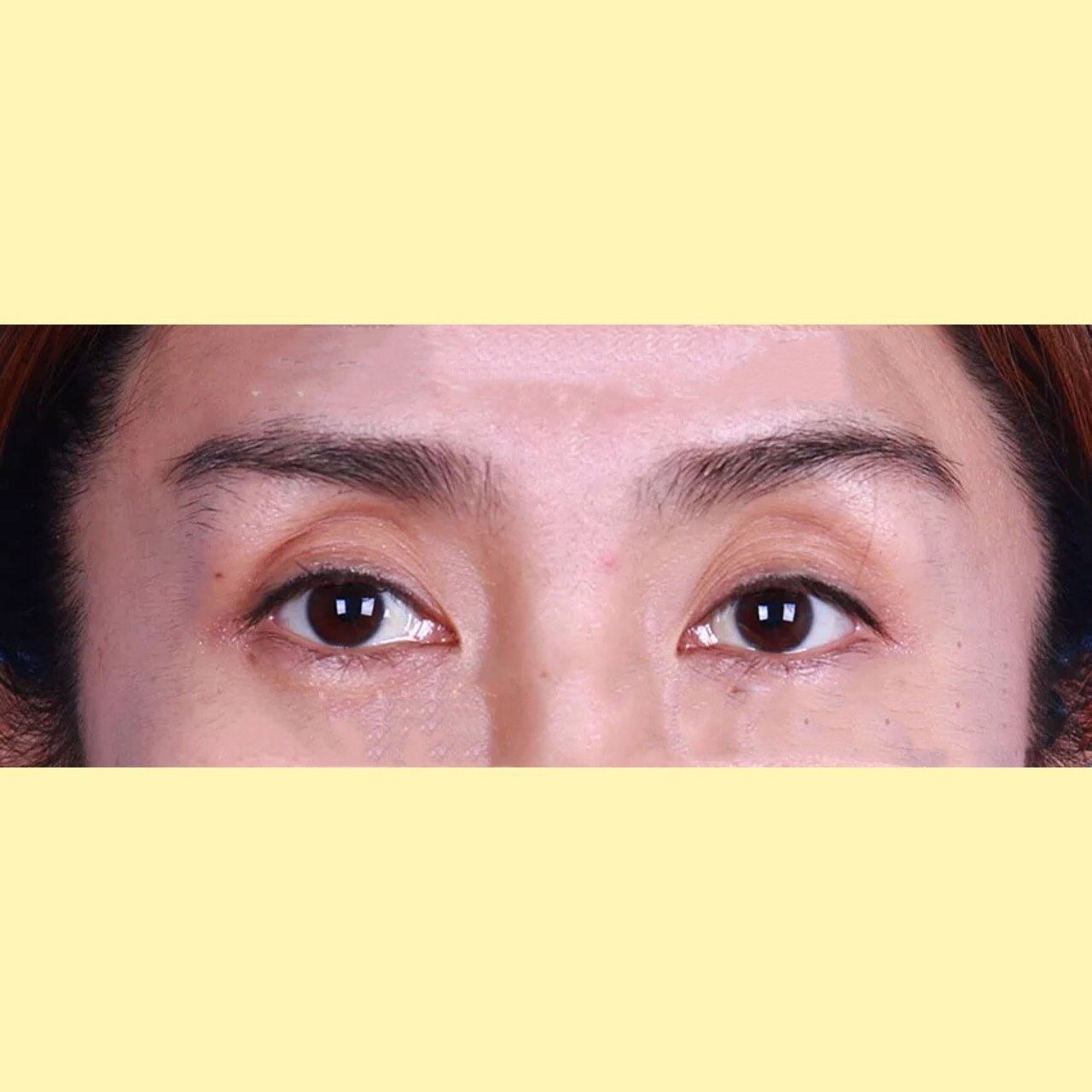72157215眼窝凹陷并不是眉骨高!