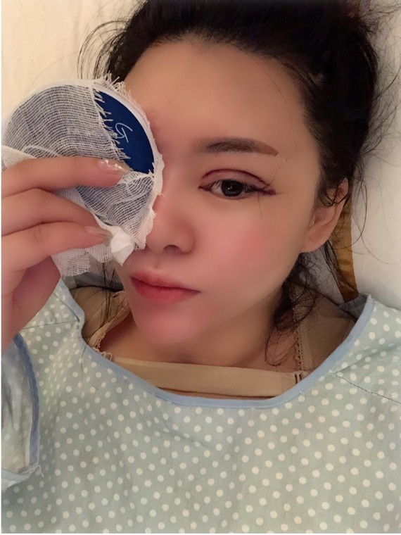 双眼皮修复第一天 好疼