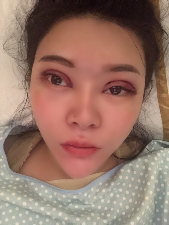 双眼皮修复第一天 好疼