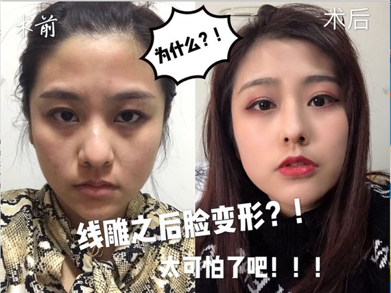 为什么有的人线雕后脸变形、线不吸收?线雕可