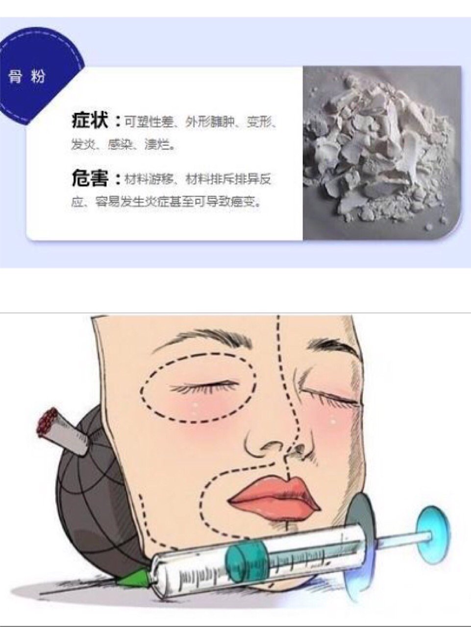 这个词语了,大家常见的隆鼻材料是膨体,硅胶,自体软骨或者玻尿酸等