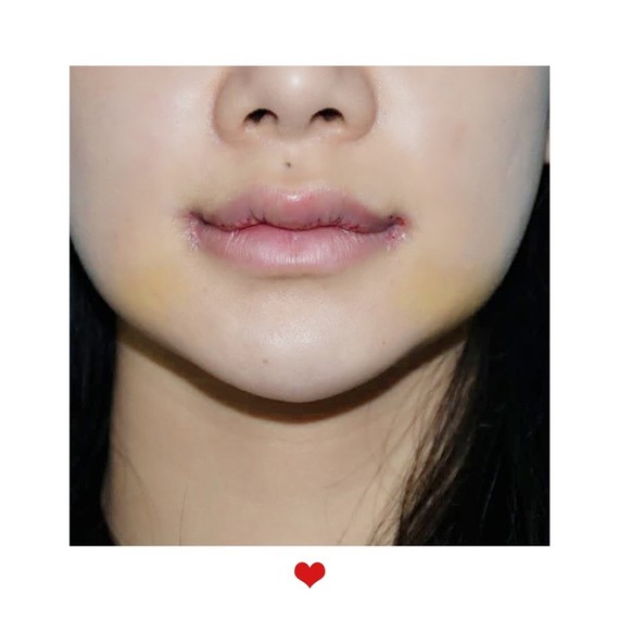 我自己的下唇两侧特别宽嘴显得厚,上唇没有唇珠,形状很平,整体就是