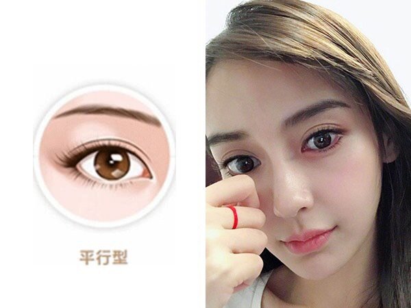 总是被大家diss又宽又假的欧式平行双眼皮,小姐姐_圈子-新氧美容整形