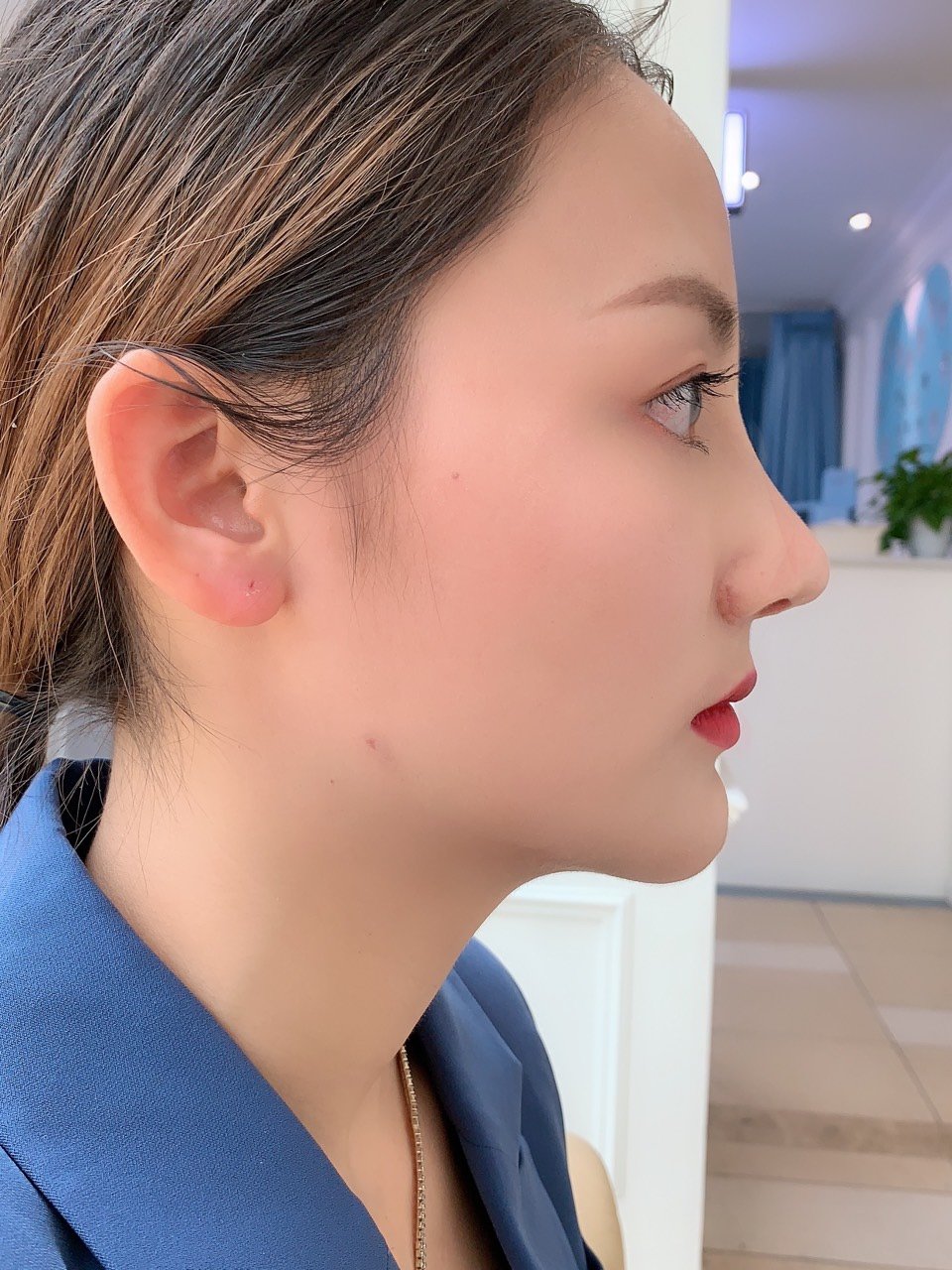 隆鼻分享闺蜜做的肋骨鼻简直不要太完美 坐标成都 价格4w