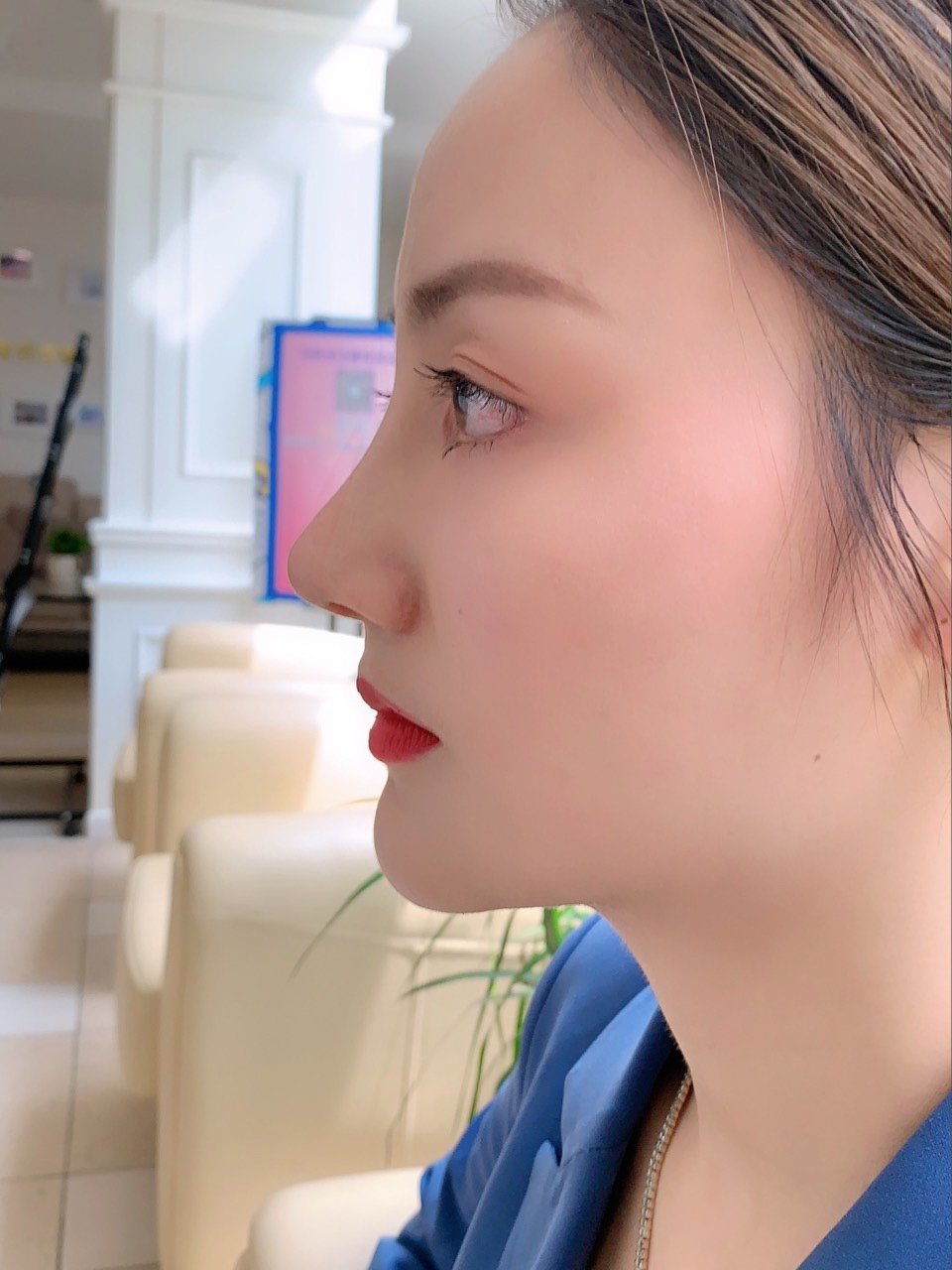 隆鼻分享闺蜜做的肋骨鼻简直不要太完美 坐标成都 价格4w