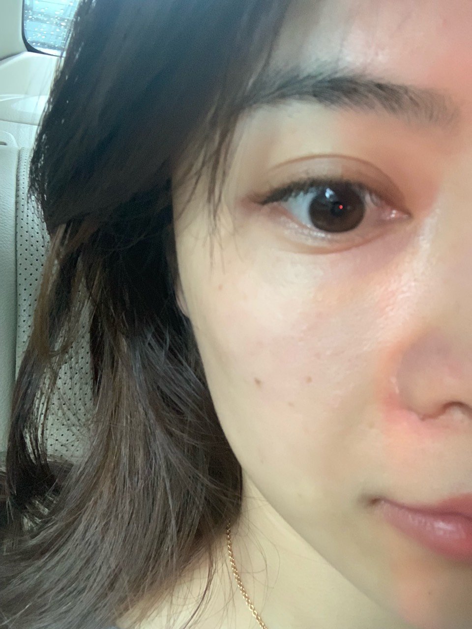 眼袋上很深一条纹路,用手按压眼袋也抚不平,请问这个_圈子-新氧美容