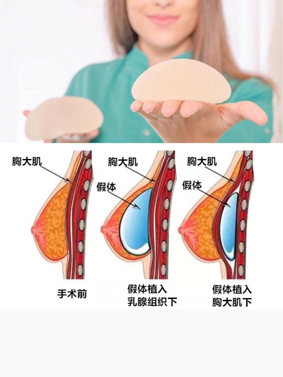 假體豐胸安全嗎做了排異怎麼辦