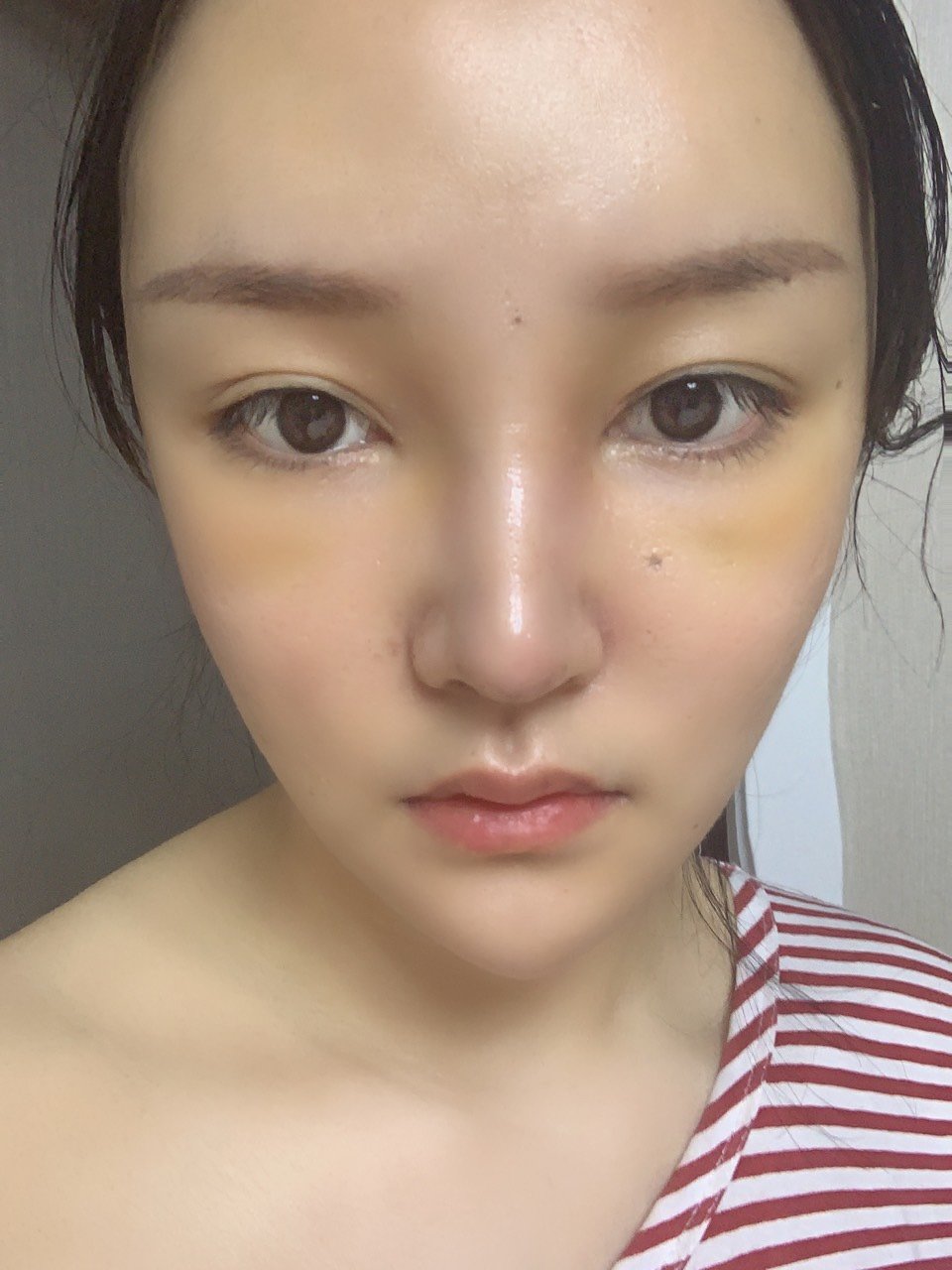 今天半肋鼻部多项术后第六天山根宽肿的厉害好像阿凡达尤_圈子-新氧