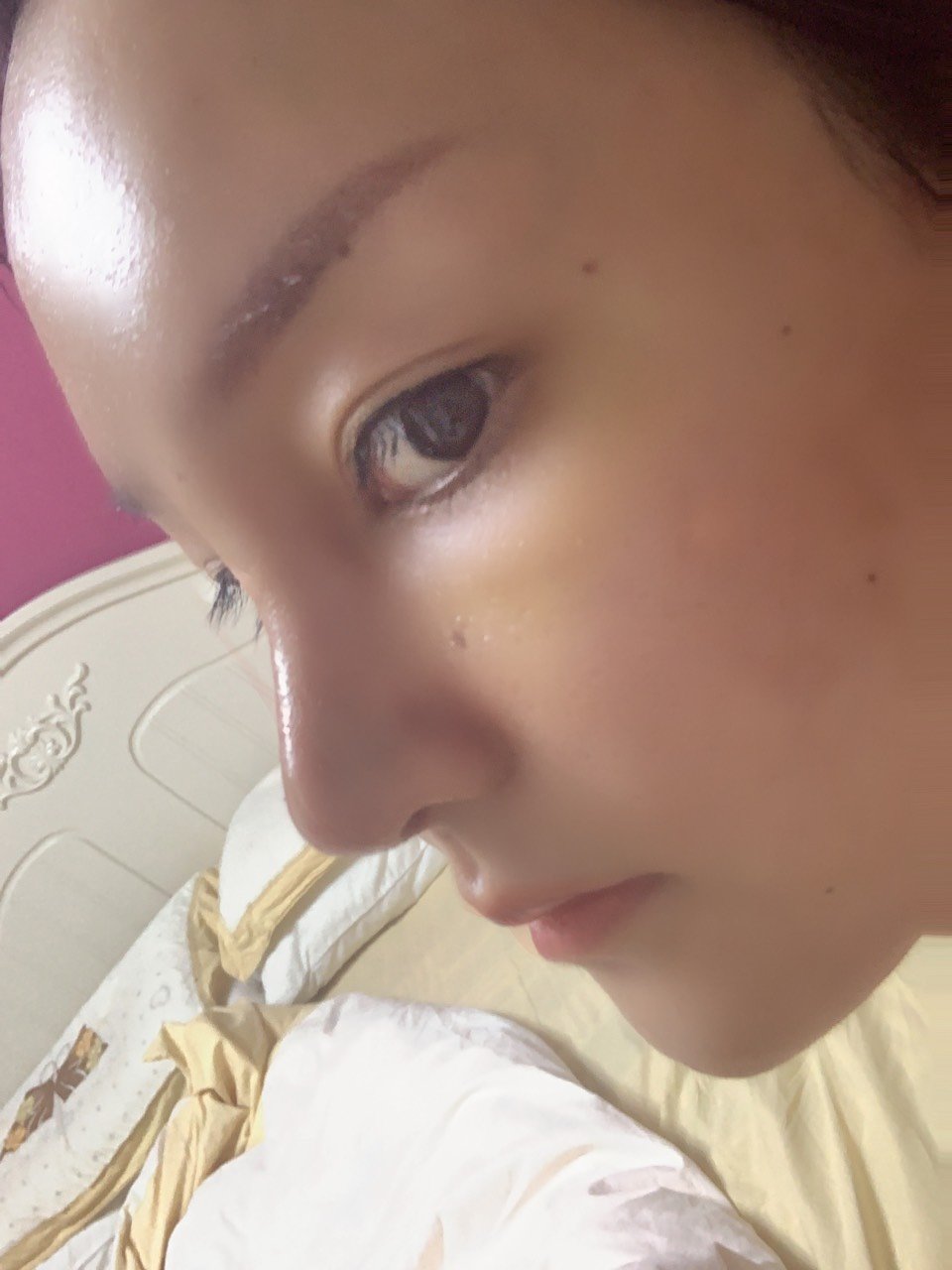 今天半肋鼻部多项术后第六天山根宽肿的厉害好像阿凡达尤_圈子-新氧